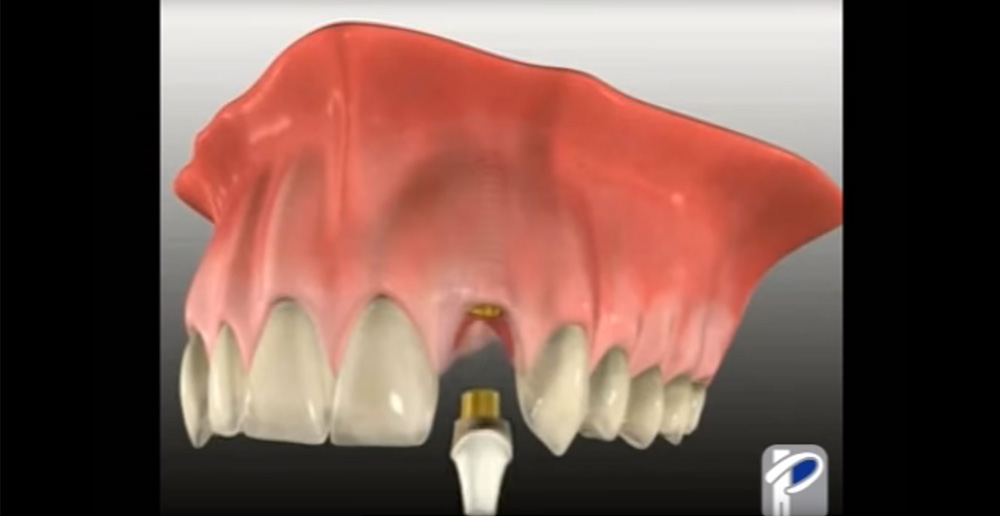 007-Dental-Implants