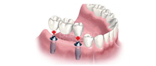 implants-dentistry-004