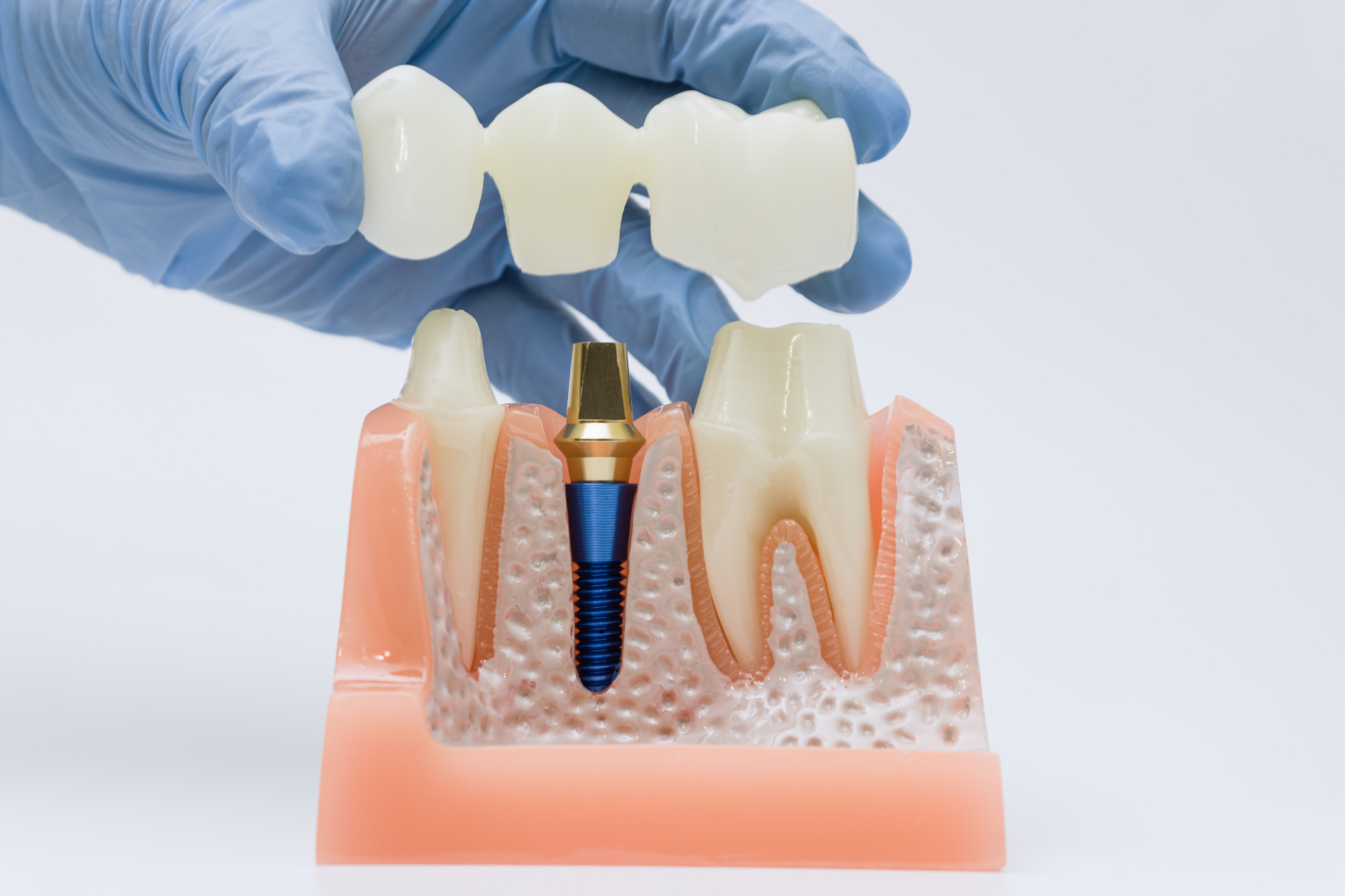 Dental Crowns
