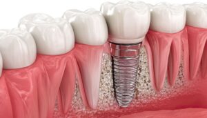 Active vs Passive Dental Implants: Differences, Benefits & Selection Guide