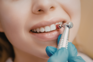 What Is Dental Bonding?